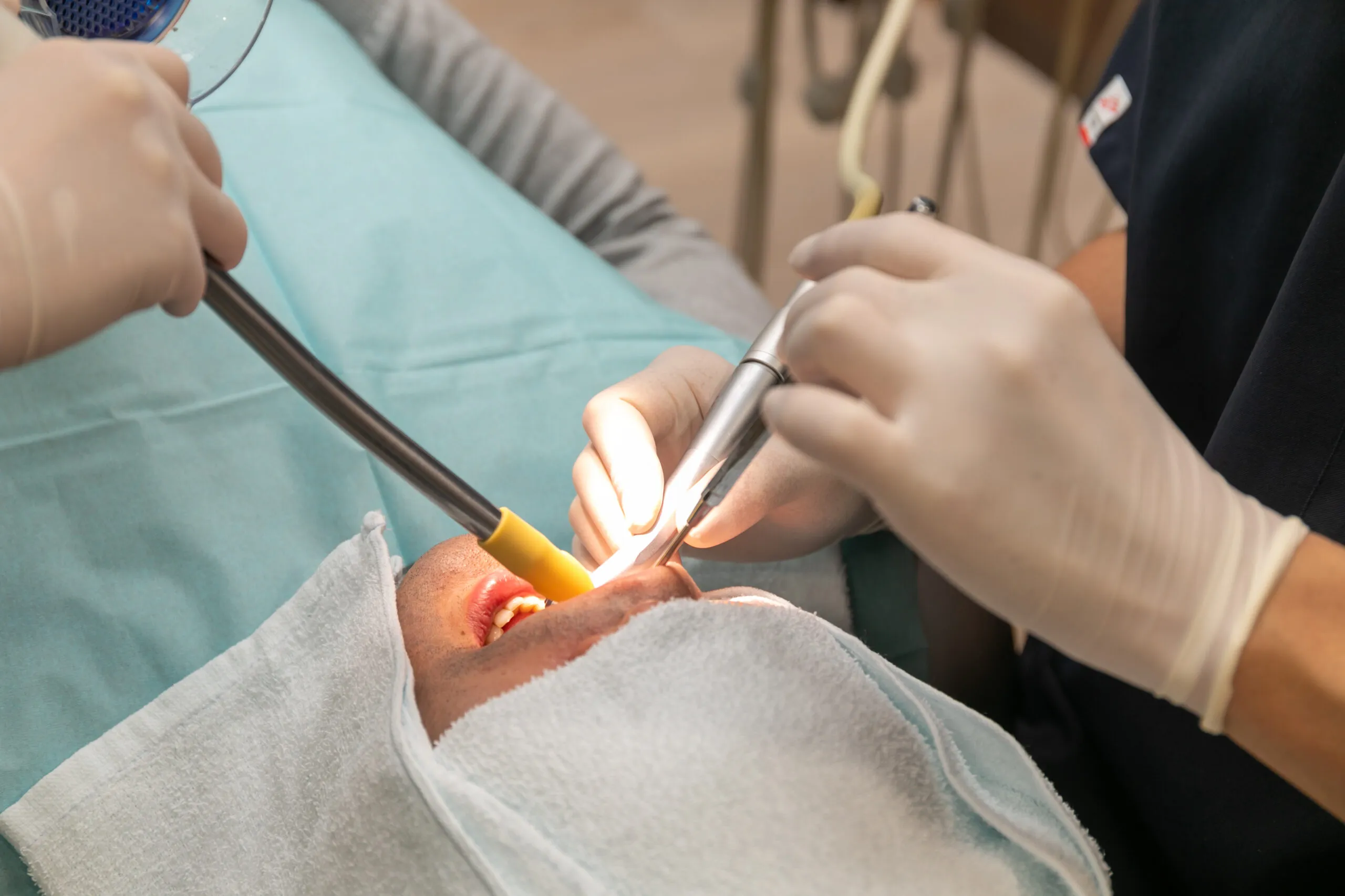 根の治療（根管治療）